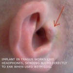 Man Gets Headphone Implanted in His Ear